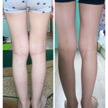 Лікувальний масаж з ЛФК для дітей при вальгусній деформації ніг та плоскостопості/Лечебный массаж с ЛФК при вальгусной деформации ног и плоскостопии
                    Массажист Ирина Днепр