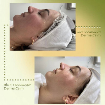 Догляд за шкірою з розацеа та куперозом
                    Косметологический центр Aesthetic Boutique Киев