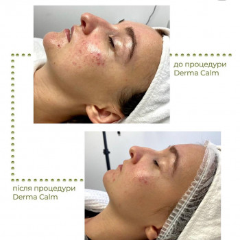 Догляд за шкірою з розацеа та куперозом
                    Косметологический центр Aesthetic Boutique Киев