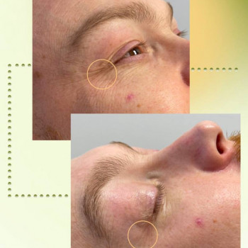 Детокс шкіри з 3Д ліфтингом
                    Косметологический центр Aesthetic Boutique Киев