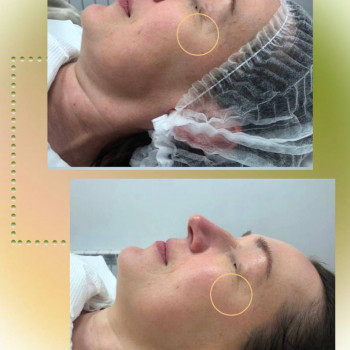 Детокс шкіри з 3Д ліфтингом
                    Косметологический центр Aesthetic Boutique Киев