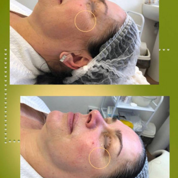 Детокс шкіри з 3Д ліфтингом
                    Косметологический центр Aesthetic Boutique Киев