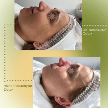 Детокс шкіри з 3Д ліфтингом
                    Косметологический центр Aesthetic Boutique Киев