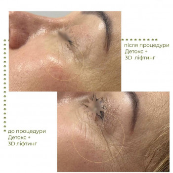 Детокс шкіри з 3Д ліфтингом
                    Косметологический центр Aesthetic Boutique Киев