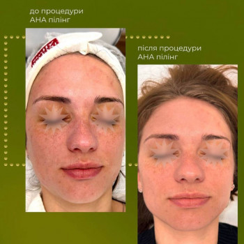 AHA-пілінг
                    Косметологический центр Aesthetic Boutique Киев