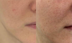 Процедура Red Carpet Glow Косметологический центр Aesthetic Boutique Киев