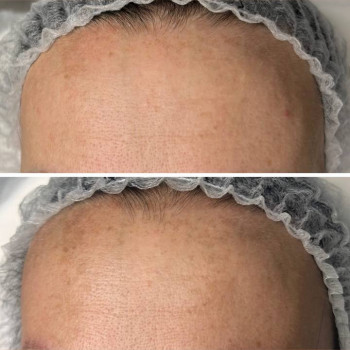 видалення пігментації 2 процедури