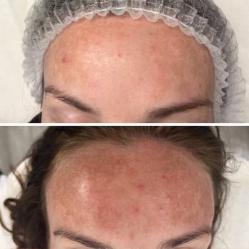 видалення пігментації 3 процедури