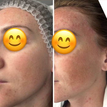 видалення пігментації 3 процедури