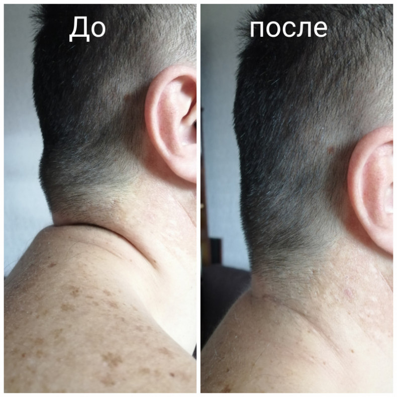 Зразу після 1 процедури
 #холка #масаждляплечей, фото - Косметолог-эстетист Инна Кожемякина
