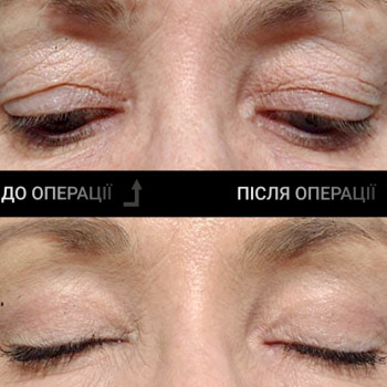 Блефаропластика
                    Пластический хирург  Львов
