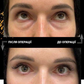 Блефаропластика
                    Пластический хирург  Львов