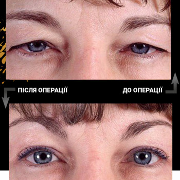 Блефаропластика
                    Пластический хирург  Львов