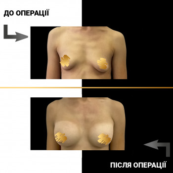 Мамопластика
                    Пластичний хірург  Львів
