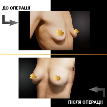 Мамопластика
                    Пластичний хірург  Львів