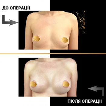 Мамопластика
                    Пластичний хірург  Львів
