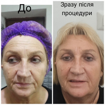 Масаж( 2 види) + пілінг, після 1 разу
  