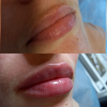  #збільшеннягуб
 #кпгуб
 #контурнапластикагуб
 #губижитомир
 #салонкрасижитомир, фото - Салон краси KOSMET