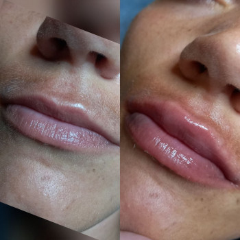  #збільшеннягуб
 #кпгуб
 #контурнапластикагуб
 #губижитомир
 #салонкрасижитомир, фото - Салон краси KOSMET