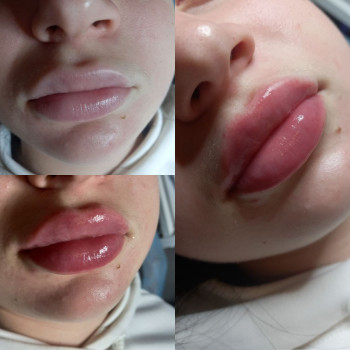 Увеличение губ контурная пластика, фото - Салон красоты КОСМЕТ