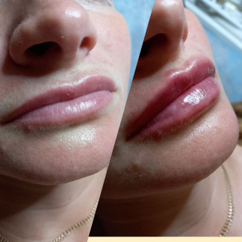  #збільшеннягуб
 #кпгуб
 #контурнапластикагуб
 #губижитомир
 #салонкрасижитомир, фото - Салон краси KOSMET