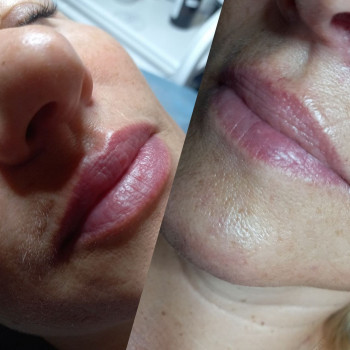  #збільшеннягуб
 #кпгуб
 #контурнапластикагуб
 #губижитомир
 #салонкрасижитомир, фото - Салон краси KOSMET