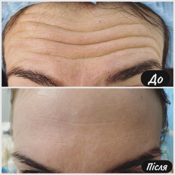 Ботулінотерапія