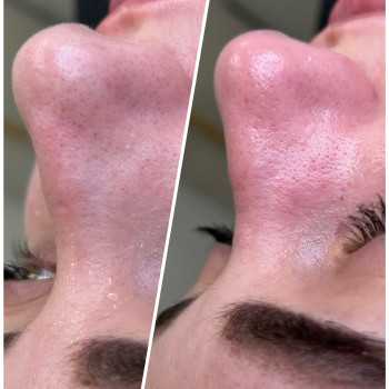 Механічна чистка