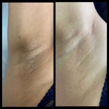 Результат зона "Пахви"