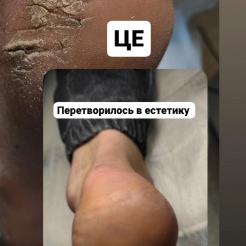 чищення п'яти