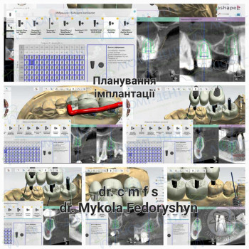 Планування імплантації зубів