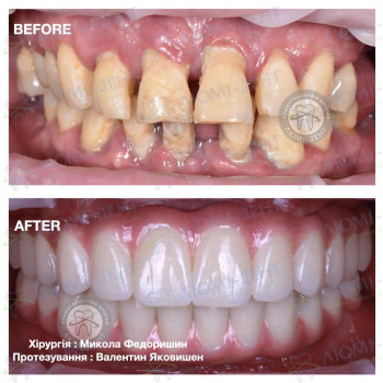 Відновлення усмішки за допомогою протоколу all-on-4