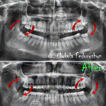 Видалення зубів мудрості перед ортодонтичним лікуванням