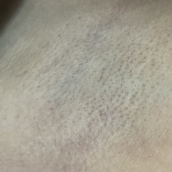 Лазерне видалення волосся
                    Майстер манікюру Анна Запоріжжя