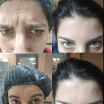 До/після - верхня третина обличчя