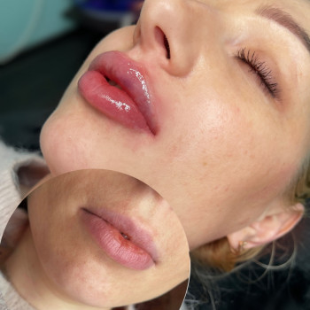 контурная пластика ?