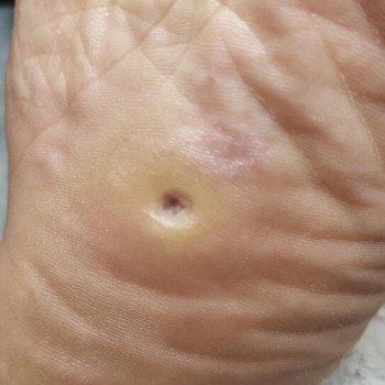 Видалення мозолі