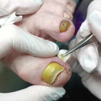 Видалення врослого нігтя
                    Ногтевая студия Центр подологии и тейпирования Запорожье