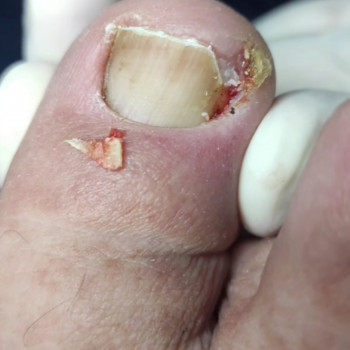 Видалення врослого нігтя
                    Ногтевая студия Центр подологии и тейпирования Запорожье