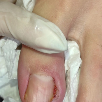 Видалення врослого нігтя
                    Ногтевая студия Центр подологии и тейпирования Запорожье