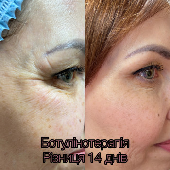 Ботокс
                    Косметолог-инъекционист Любов Запорожье