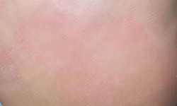 Чистка пʼятки Подолог  Шпола