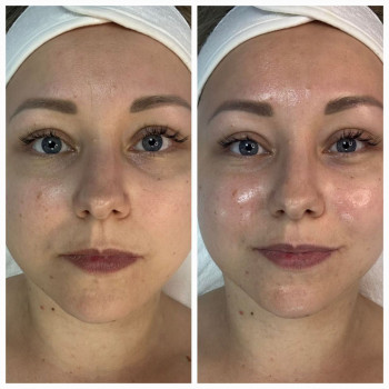 PRX t33 терапія