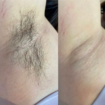 Пахви шугаринг