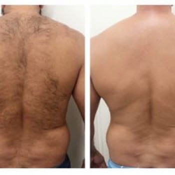 Спина
Шугаринг Чоловічий