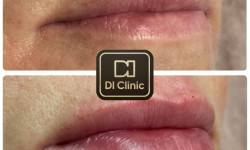 Збільшення губ Медичний центр DIClinic Київ