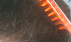 Дарсонвалізація Майстер депіляції Юлия Черкаси