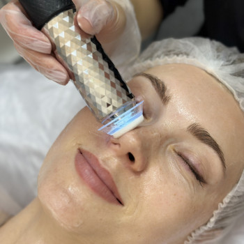 Карбоксітерапія