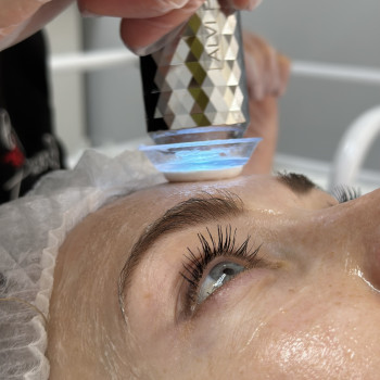 Карбоксітерапія