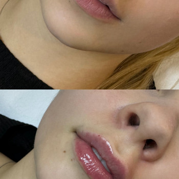 Контурна пластика губок